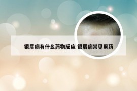 银屑病有什么药物反应 银屑病常见用药