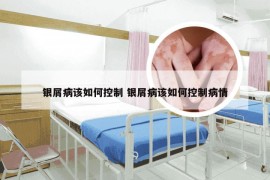 银屑病该如何控制 银屑病该如何控制病情