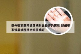 郑州哪家医院银屑病科比较好的医院 郑州哪家银屑病医院治银屑病好