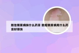 脓包银屑病抹什么药膏 脓疱银屑病用什么药膏好得快