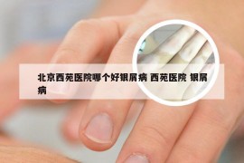 北京西苑医院哪个好银屑病 西苑医院 银屑病