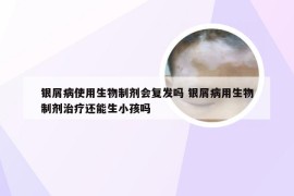 银屑病使用生物制剂会复发吗 银屑病用生物制剂治疗还能生小孩吗