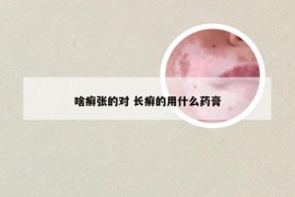 啥癣张的对 长癣的用什么药膏