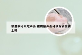 银屑病可以吃芦荟 银屑病芦荟可以涂到皮肤上吗