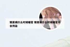 银屑病什么时候睡觉 银屑病什么时候睡觉不会传染