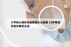 十岁的小孩长头皮癣是什么原因 10岁男孩头皮长癣怎么治