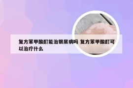 复方苯甲酸酊能治银屑病吗 复方苯甲酸酊可以治疗什么