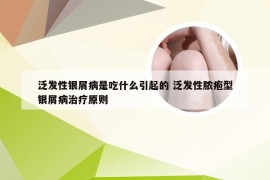 泛发性银屑病是吃什么引起的 泛发性脓疱型银屑病治疗原则