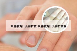 银屑病为什么会扩散 银屑病为什么会扩散呢