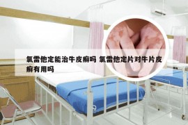 氯雷他定能治牛皮癣吗 氯雷他定片对牛片皮癣有用吗