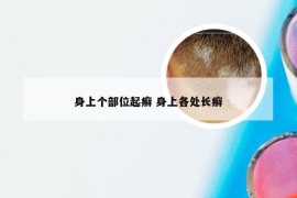 身上个部位起癣 身上各处长癣