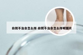 白斑不治会怎么样 白斑不治会怎么样呢图片