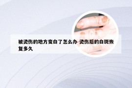 被烫伤的地方变白了怎么办 烫伤后的白斑恢复多久