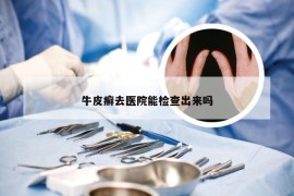 牛皮癣去医院能检查出来吗