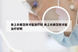 身上长癣怎样才能治疗好 身上长癣怎样才能治疗好呢