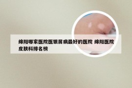 绵阳哪家医院医银屑病最好的医院 绵阳医院皮肤科排名榜