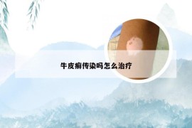 牛皮癣传染吗怎么治疗