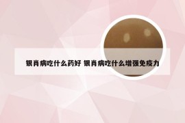 银肖病吃什么药好 银肖病吃什么增强免疫力