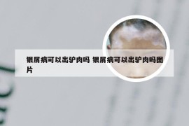 银屑病可以出驴肉吗 银屑病可以出驴肉吗图片