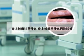 身上长癣注意什么 身上长癣用什么药比较好