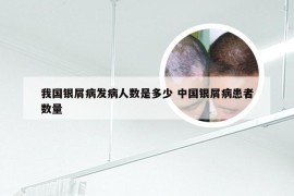 我国银屑病发病人数是多少 中国银屑病患者数量