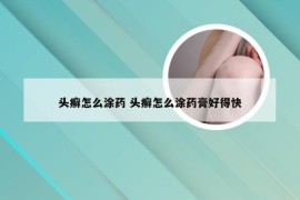 头癣怎么涂药 头癣怎么涂药膏好得快