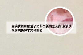 点滴状银屑病消了又长出新的怎么办 点滴状银屑病快好了又长新的