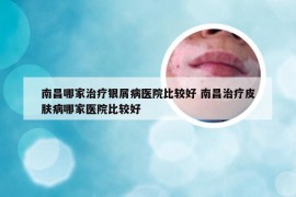 南昌哪家治疗银屑病医院比较好 南昌治疗皮肤病哪家医院比较好