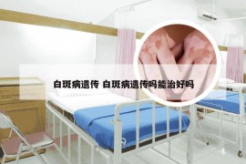 白斑病遗传 白斑病遗传吗能治好吗