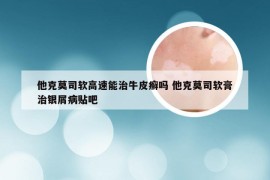 他克莫司软高速能治牛皮癣吗 他克莫司软膏治银屑病贴吧