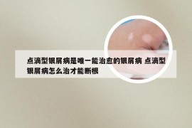 点滴型银屑病是唯一能治愈的银屑病 点滴型银屑病怎么治才能断根