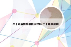 二十年后银屑病能治好吗 三十年银屑病