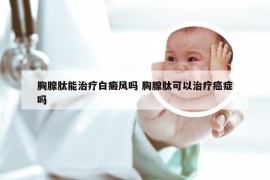 胸腺肽能治疗白癜风吗 胸腺肽可以治疗癌症吗