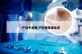 产后牛皮癣 产后银屑病自愈