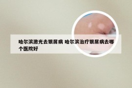 哈尔滨激光去银屑病 哈尔滨治疗银屑病去哪个医院好