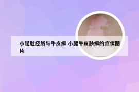 小腿肚经络与牛皮癣 小腿牛皮肤癣的症状图片