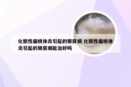 化脓性扁桃体炎引起的银屑病 化脓性扁桃体炎引起的银屑病能治好吗