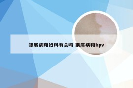 银屑病和妇科有关吗 银屑病和hpv