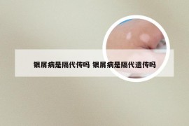 银屑病是隔代传吗 银屑病是隔代遗传吗