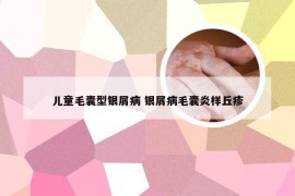 儿童毛囊型银屑病 银屑病毛囊炎样丘疹