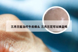 三月兰能治疗牛皮癣么 三月兰花可以换盆吗