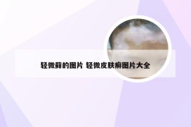 轻微藓的图片 轻微皮肤癣图片大全