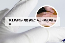 头上长癣什么药能够治疗 头上长癣能不能治好