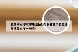 银屑病吃转移药可以治愈吗 转移因子胶囊银屑病要吃几个疗程?