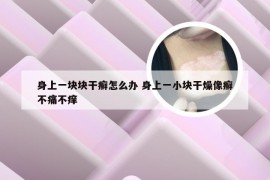 身上一块块干癣怎么办 身上一小块干燥像癣不痛不痒