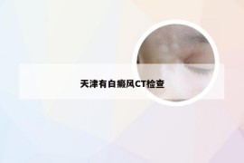 天津有白癜风CT检查