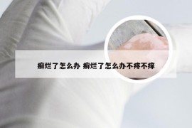 癣烂了怎么办 癣烂了怎么办不疼不痒