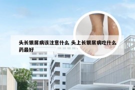 头长银屑病该注意什么 头上长银屑病吃什么药最好