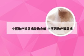 中医治疗银屑病能治愈嘛 中医药治疗银屑病