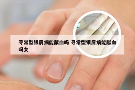 寻常型银屑病能献血吗 寻常型银屑病能献血吗女